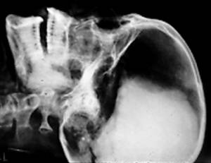 Röntgenbild von Ramses III